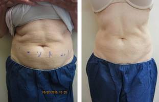Collsculpting abdomen Dr Varano Washington DC Collsculpting abdomen Dr Varano Washington DC
